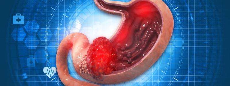 Magenbypass OP Kosten & Preise